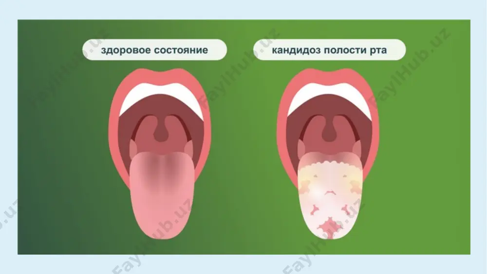 езодорловчи хусусиятга эга. шунингдек, махаллий ишлатиш учун гексорал, гексидинни аэрозол, эритмаларини ишлатиш мумкин, улар хам стопангин сингари даволовчи хусусиятга эга. профилактика. аёллар консультациясидан бошлаб кандидозни даволаш ўтќазилади ва бола туѓилиши билан оѓзига нистатинни суспензияси томизилади. тиш протезлари бор беморларда оѓиз бўшлиѓи ва протезларга бериладиган парвариш доимий равишда олиб борилади. узоќ муддат антибиотик ва сульфаниламидлар ќабул ќилганларга кандидозни профилактика ќилиш маќсадида нистатин ёки леворин 1500 000 ед бир кунда, в ва с гурућ витаминлари буюрилади. e'tiboringiz uchun tashakkur @dr_zakiroff +99891 279 54 56 image3.jpeg image4.png image5.jpeg image6.jpeg image7.png image8.jpeg image9.jpeg image10.png image11.jpeg image12.jpeg image13.jpeg image14.jpeg image15.jpeg image16.jpeg image17.jpeg image18.png image19.png image20.png image1.png /docprops/thumbnail.jpeg