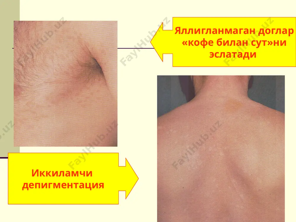 ливидным оттенком 2. средняя зона: эрозии с блестящей, мокну-ющей, ярко-красной поверхностью периферия: новые везикулы, эрозии. эпидермис отслаивается в виде бахромки. три зоны в очагах руброфитии: гиперкератотическая руброфития возникают эрозии беспокоит зуд, затем возникает болезненность, усиливающаяся при ходьбе процесс распространяется на кожу подпальцевых складок и свод стопы. на эритематозно-отёчном фоне – поверхностные везикулы («зёрна саго») везикулы изолированные или сливаются в многокамерные пузыри дисгидротическая эпидермофития стоп дисгидротическая эпидермофития стоп содержимое везикул вначале прозрачное при присоединении пиогенной флоры – содержимое мутнеет везикулы вскрываются с образованием эрозий, окаймлённых отслаивающимся эпителием поверхность эрозий покрывается гнойно-геморра- гическими корками иногда возникают лимфангиты и лимфадениты ухудшается общее состояние сквамозная форма эпидермофитии стоп протекает сравнительно легко возможно развитие незначительной воспали- тельной реакции часто процесс начинается с iii, iv межпаль- цевых складок онихомикозы трихофития фавус эпидермофития рубромикоз кандидоз поражение ногтей при некоторых микозах в россии, западноевропейских странах и сша около 80% всех случаев онихомикозов вызвано т. rubrum. на втором месте …