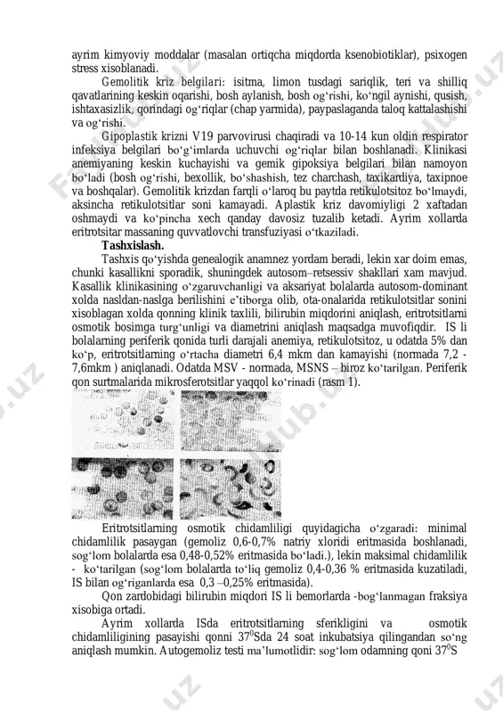 a bo‘lsa ham normal xisoblanadi (75-80 fl). nihoyat, shuni eslatib o‘tmoqchimizki, is da eritrotsitlarning aniq biokimyoviy nuqsoni tasdiqlanmagan, va xisoblashlaricha u is li turli gurux bemorlarda geterogendir. klinikasi. kasallikning klinik ko‘rinishi turli bemorlarda, turli oilalarda o‘zgacha bo‘ladi. belgilarning triadasi xos: axlatning rangi normada bo‘lgan xolda sariqlik, yaqqol retikulotsitozli anemiya va taloqning kattalashishi. ular chaqaloqlik davridagi va katta maktab yoshidagi bolalarda xam kuzatiladi. gemolitik triada qancha erta namoyon bo‘lsa, is shuncha og‘ir kechadi. lekin qoidaga asosan ko‘proq yaqqol sariqlik maktabgacha va kichik maktab yoshidagi bolalarda namoyon bo‘ladi. bir qator bemorlarda ota-onasining dastlabki shikoyatlari - bola tez charchashi, rangparlik, ishtaxasizlik – xisoblanadi. kattaroq bolalar ko‘prok bosh og‘rishi, bosh aylanishidan shikoyat qiladi. ayrim bolalarda sariqlikdan ko‘ra oqarishi ustuvordir, ayrimlarida esa buning aksi. bu xolat to‘la aniq bo‘lmagan mexanizmlarga bog‘liq. kasallik uzoq muddat kechganda yassi suyaklarni diploetik bo‘shliqlarini kengayishi evaziga «minorasimon bosh» rivojlanishi mumkin. bu xol, tallasemiyadagidan engilroq kechadi. qator mualliflar bu simptomokompleksni genetik …