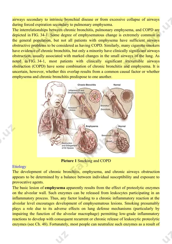 hanisms. in the absence of severe deficiency of ai-globulin in the serum, however, the factors which make some cigarette smokers more susceptible to development of emphysema than others remain uncertain. it is also uncertain why persons with similar degrees of emphysema may have considerably varying degrees of severity of airways obstruction. with sufficient exposure to bronchial irritants, particularly cigarette smoke, most persons develop some degree of chronic bronchitis. the lesion essential to development of severe airways obstruction is apparently located in the small airways and may be basically different from the ordinary large airways abnormality which leads to hypersecretion of mucus in most smokers. the reason why small airways abnormalities develop in some patients with chronic bronchitis is uncertain, but viral or bacterial pulmonary infections in childhood, an unidentified immunologic mechanism, a mildly impaired ability to inactivate proteolytic enzymes (as in heterozygotic antitrypsin deficiency), or unidentified genetic characteristics could be …