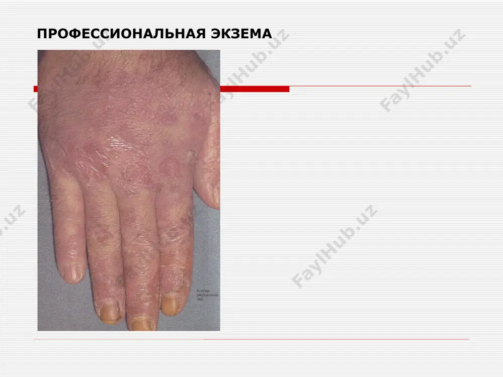 алликларни даволаш сутли-усимли диета дегельминтизация мехнат шароитларини яхшилаш атопик дерматит наслдан утадиган аллергик дерматоз сурункали кечувчи , кайталанувчи дерматоз. кичишиш, эритема, тугунчалар пайдо булади, лихенизации эшак еми уткир ва сурункали кечувчи бирламчи тошма – уртика дифференциал диагноз -дерматит дюринг билан эшак еми нейродермит хроническое воспалительное заболевание кожи, характеризующеся оформираваний эритематознолихеноидных высыпаний со склоностью к слиянию с образованием очагов папулезной инфильтрации и лихенизации кожи в типичных зонах. нейродермиты чегараланган диффуз 3 зона марказий (лихенизация ) урта (папулезная) периферик (гиперпигментация ) киесий ташхис сурункали кечувчи экзема кичима кичима сурункали кечувчи дерматоз тугунчаларни устида папулалар хосил булади турлари : боллар кичимаси (строфулюс) катталар кичимаси тугунли кичима дифференциал ташхис –нейродермит, кпл даволаш комплексное ликвидация нервных, нейроэндокринных нарушений санация очагов инфекции гипоаллергическая диета седативные средства гипосенсибилизирующая терапия иммунокорригирующие средства image1.png image2.png image3.png image4.png image5.png image6.png image7.png image8.png image9.jpeg image10.png image11.png image12.png image13.jpeg image14.jpeg /docprops/thumbnail.jpeg