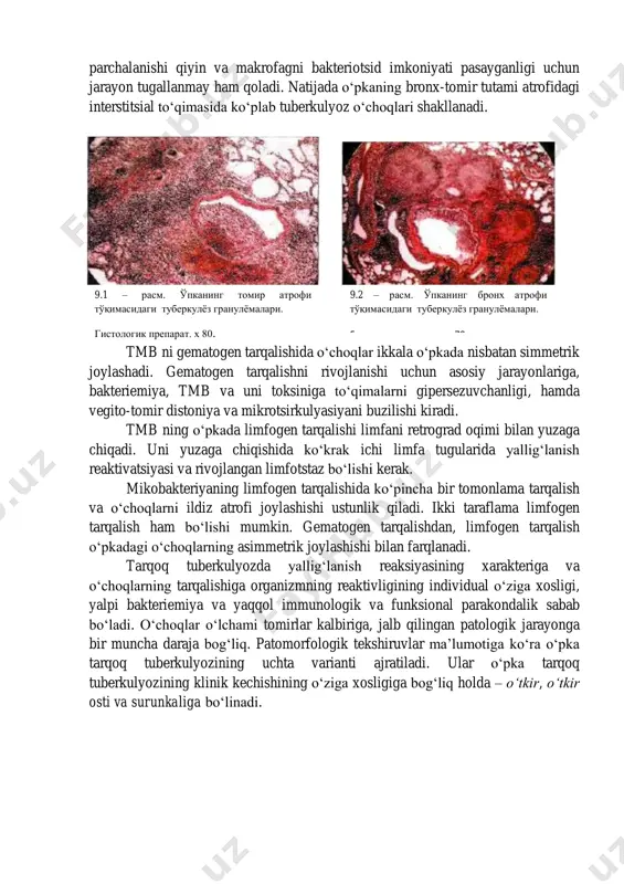 irdan ortadi. bunday sharoitda tmb tomir atroifdagi to‘qimaga qondan erkin va etarlicha o‘tishi mumkin. tarqoq tuberkulyozning rivojlanishi uchun asab va tomir tizmining funksional holatini o‘zgarishi muhim ahamiyatga ega. kortiko-vitseral boshqaruvni parokandaligi, vegito-tomir distoniyasi va mikrotsirkulyasiyaning buzilishiga natijada, mayda tomirlarda qon oqimining sekinlashuvi va atrofdagi to‘qimalardagi tmb ni tomir devori orqali qonga tushishiga olib keladi. tuberkulyoz infeksiyasining birlamchi davrida hujayralarni mikobakteriyalarga sezgirligi oshishini shakllanishi davrida makrofag tmbni tez yutishini ta’minlaydi, keyin tomir atrofi to‘qimasiga tmb ni aralshishi va o‘tirish qobilyatini yo‘qoladi. mikobakteriyaning keyingi harakati to‘htaydi, ammo uni parchalanishi qiyin va makrofagni bakteriotsid imkoniyati pasayganligi uchun jarayon tugallanmay ham qoladi. natijada o‘pkaning bronx-tomir tutami atrofidagi interstitsial to‘qimasida ko‘plab tuberkulyoz o‘choqlari shakllanadi. tmb ni gematogen tarqalishida o‘choqlar ikkala o‘pkada nisbatan simmetrik joylashadi. gematogen tarqalishni rivojlanishi uchun asosiy jarayonlariga, bakteriemiya, tmb va uni toksiniga to‘qimalarni gipersezuvchanligi, hamda vegito-tomir distoniya va mikrotsirkulyasiyani buzilishi kiradi. tmb ning o‘pkada limfogen tarqalishi limfani retrograd oqimi bilan yuzaga chiqadi. …