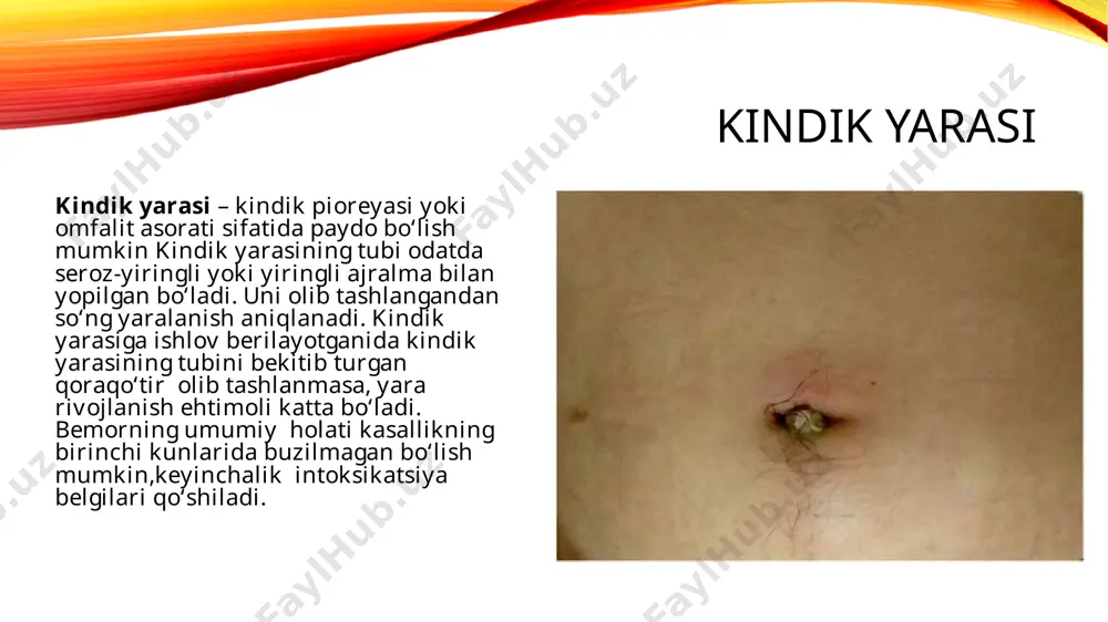 sion to‘qima bo‘lagi. belgilari:kindik sohasidan suyuqlik ajralishi.qizarish va namlik.harorat va yallig‘lanish belgilarisiz. sabablar;:kindik ipi to‘g‘ri tushmasligi yoki qurimasligi.to‘qimalarning haddan tashqari o‘sishi (granulyatsiya). davolash:mahalliy antiseptiklar.kichik granulomalarni 2-3%li kumush nitrat bilan kuydirish.katta granulomalar uchun jarrohlik yo‘li bilan olib tashlash. uruxipus (urachus) uruxipus (urachus) qoldiqlari bilan bog‘liq anomaliyalar urachus – homilalik davrida siydik pufagini kindikka bog‘laydigan embrional tuzilma. bu tuzilmaning to‘liq yopilmasligi turli klinik holatlarga olib keladi. turlari:to‘liq ochiq urachus: siydik kindikdan chiqadi.urachus kistasi: yopiq qopcha shaklida.urachus sinus: kindik tomoni ochiq.urachus divertikul: siydik pufagi tomoni ochiq. belgilari:kindikdan siydikga o‘xshash suyuqlik ajralishi.davriy yallig‘lanish.shish yoki og‘riq bo‘lishi mumkin. davolash:uzi va sistografiya bilan aniqlash.jarrohlik yo‘li bilan urachus qoldiqlarini olib tashlash. kindik polipi (polypus umbilicalis) kindik polipi (polypus umbilicalis)bu – kindikda joylashgan, epitelial qoplamga ega, ko‘pincha ichki ichak to‘qimalaridan tashkil topgan tuguncha. belgilari:qizil, ko‘kimtir rangli, kindik ichida o‘suvchi tuguncha.suyuqlik ajralishi.qattiqroq va o‘zgarishsiz granulomadan farq qiladi. davolash:kichik poliplar mahalliy antiseptiklar bilan kuzatiladi.kattaroqlari yoki yallig‘langan holatlarda jarrohlik yo‘li bilan …