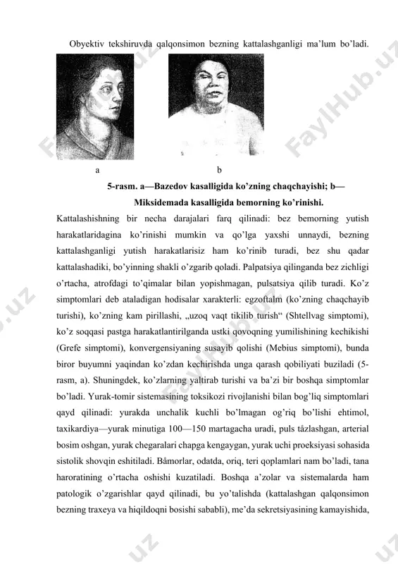 ichishga beriladi, kuniga 2—3 marta 0,05 g dan diyodtirozin (3 haftalik kurs), radioaktiv yod bilan davolash buyuriladi. merkazolil 0,005 g dan kuniga 2—3 marta, ovqatdan keyin buyuriladi. bundan tashqari, simptomatik davo qilinadi, sedativ, yurak-tomir vositalari, qator hollarda xirurgik davo qilish zarur. endemik buqoq endemik buqoq deb, patologik kattalashgan qalqonsimon bezga aytiladi. kasallik odamni o’rab turgan muhitda yod miqdorining kamayib ketishiga bog’liq, bu holat ovqat mahsulotlari va ichimlik suvining yodga kam to’yinishiga va binobarin, organizmga yodning kam tushishiga olib keladi. joy balandligi dengiz sathidan nechog’liq yuqorilashgani sayin tuproq va suvdagi yod miqdori kamayib boradi. bu qator omillar bilan, xususan, tog’dan oqib kelayotgan suvning tuproqdagi yod saqlaydigan jinslarni yuvib ketishi bilan bog’liq. tog’li rayonlar (farg’ona vodiysi va boshqa rayonlar kiradi), adirlar — endemik buqoq tarqalgan joylardir. biroq endemik buqoq bo’yicha tinch bo’lmagan joylarda ko’pchilik shaxslarda bu kasallik paydo bo’lmaydi. binobarin, bu kasallikning paydo bo’lishiga tashqi muhitda yod yetishmasligidan tashqari, boshqa omillar ham …