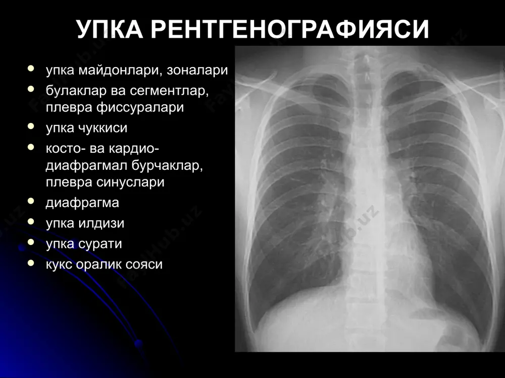 улчами 4-6 см чегараси ноаник/ нотекис ногомоген (парчаланиш) «илдизга йул» + плеврит тез усади рак ичида кальцинат хеч качон булмайди !! гамартома эркаклар 50-60 ешда купрок упканинг перифериясида улчами 2.5 см гача чегараси аник кальцинатлар секин усади аденома ёшларда купрок марказда (бронх ичида) усмани узи купинча куринмади упкада - гипо/гипер/гипо вентиляция ва ателектаз, еки сурункали пневмония куринса – 2 см гача, юмалок, гомоген, аник текис чегара. бошка шарсимон патология шарсимон пневмония - клиникаси уткир!, чегаралари нотекис, тез динамика метастазлар - «упкадаги тангалар» симптоми, чегараси текис гомоген бир улчамдаги соялар упкадан ташкари патология - ярим шар/овал, линза шаклида, кенг асосда чикиб келган жойида «утиради» халкасимон корайиш касалликлар - хаволи киста, каверна, абсцесс, периферик рак, поликистоз, бронхоэктазлар девори калин бир текис эмас - периферик рак (+бошка белгилар) девори калин бир текис - абсцесс, каверна. атрофда инфильтрация. абсцессда - суюклик даражаси, каверна курук+ юкорида+учокли узгаришлар. девори юпка бир текис - хаволи киста, санацияланган …