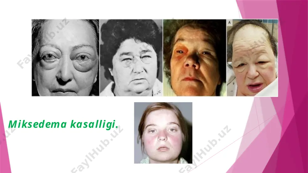 chap buyrak ustida joylashgan, birmuncha yassilashgan piraxnidalar shakliga ega. har bir bez tashqi po‘stloq va ichki mag'iz qismlardan iborat. bezlarning po‘stloq qismi suv, tuz, oqsil va uglevodlar almashinuviga ta’sir ko‘rsatadigan gormonlar ishlab chiqaradi. androgen va estrogen gormonlari jinsiy bezlar faoliyatini kuchaytiradi. buyrakusti bezi shish kasalligida jinsiy gormonlar ishlab chiqarilishi kuchayib, yosh bolalarda erta balog'atga yetish belgilarini paydo qiladi. buyrakusti bezlari buyrakusti bezlari image1.jpeg image2.jpeg image3.jpeg image4.jpeg image5.jpeg image6.jpeg image14.png image15.png image16.png audio1.wav image7.png image8.png image9.png image10.png image11.png image12.png image13.png image17.png image18.png image19.png image20.png image21.png image22.png image23.jpeg image24.png image25.png image28.png image26.png image27.png image29.png image30.png image31.png image32.png image33.png image39.png image40.png image34.png image35.png image36.png image37.png image38.png image47.png image48.png image49.png image50.png image51.png image41.png image42.png image43.png image44.png image45.png image46.png image58.png image52.png image53.png image54.png image55.png image56.png image57.png image59.png image60.png image61.png image62.png media1.m4v image63.png