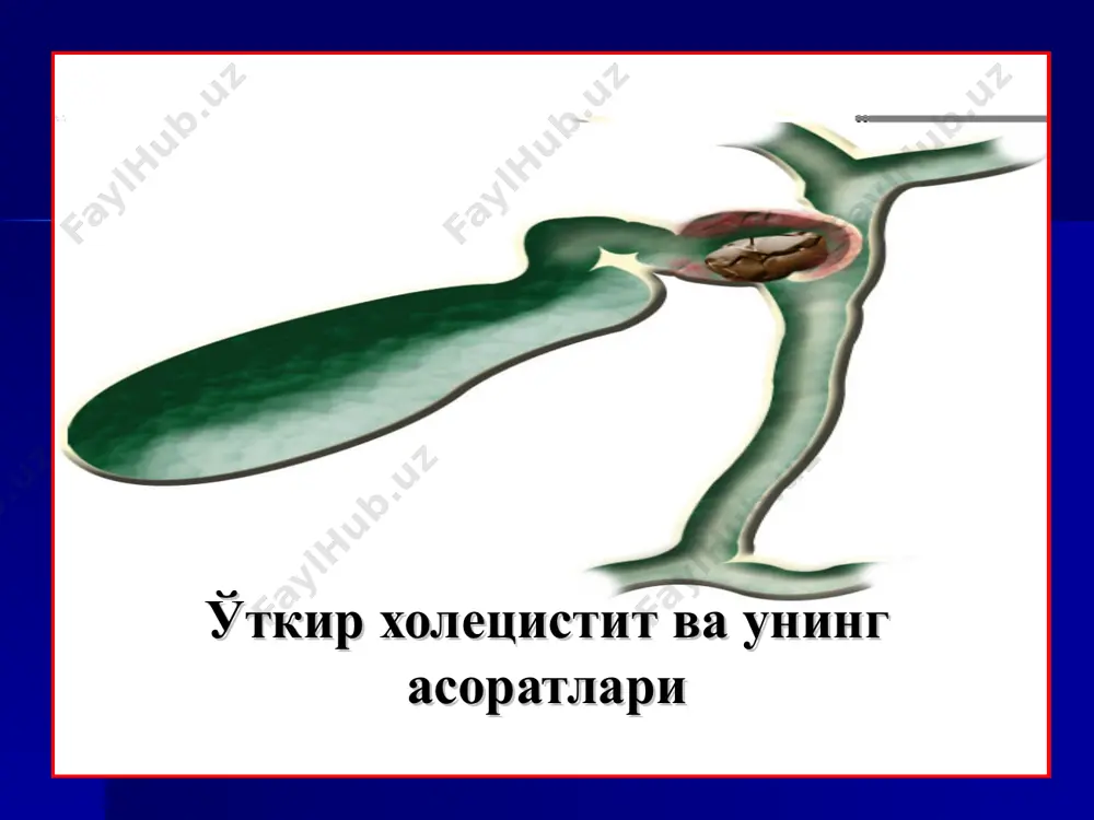 urlari: - obturatsion xoletsistit (o't qopi yo'lini obtura- tsiyasi, o't qopining is-tisqosi) xoledox obturatsiyasi (xoledoxolitiaz, katta duodenal so'rg'ich stenozi, pankreatit) o't yo'llari gipertenziyasi (toshlar, tashqi blok) infektsiya o't qopi arteriyasining trombozi jarohatlar ikkilamchi yallig'lanish o'tkir xoletsistit etiopatogenezi o'tkir xoletsistitning klinik manzarasi sub'ektiv belgilar: o'ng qovurg'a ravog'i ostida og'riq og'riq irradiatsiyasi ko'ngil aynishi og'izda achchiq ta'm va qurishi jig'ildon qaynashi qayt qilish og'riqning ovqat bilan bog'liq ligi qorinning dam bo'lishi ob'ektiv belgilar kattalashgan o't qopi qorin devori tarangligi simptomlar: merfi, myussi, grekov-ortner, reflektor stenokardiya temperatura ortishi leykotsitoz echt ning ortishi diagnostikasi noinvaziv ultratovushli tekshiruv rentgenografiya kompyuter tomografiya magnit-rezonans tomografiya invaziv usullar ante- i retrograd xolangiografiya laparoskopiya qalinlashgan devor va paravezikulyar yiring o't qopi bo'yinchasidagi tosh o'tkir xoletsistitda utt manzarasi asoratlangan o'tkir xoletsistit utt paravezikulyar abstsess paravezikulyar infiltrat kompyuter tomografiya konkrementlar o't qopi o'tkir gangrenoz xoletsistit o'tkir xoletsistit laparoskopik ko'rinishi endoskopik retrograd xolangiopankreatikografiya (erpxg) antegrad xolangiografiya (tjoxg) o'tkir xoletsistit asoratlari perforatsiya va …