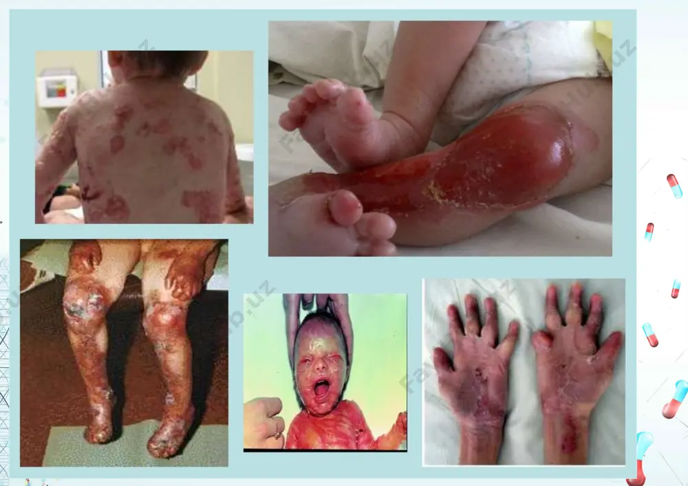 shi mumkin: ·infektsiyalari: ochiq pufakchalar infektsiyalanishi mumkin, bu esajiddiy sog'liq muammolariga olib keladi. ·skarlaydilar: qayta pufakchalar harakatchanlik va tashqi ko'rinishga ta'sir qiluvchi sezilarli chandiqlarga olib kelishi mumkin. ·oziqlanish etishmovchiligi: og'iz bo'shlig'idagi pufakchalar tufayli ovqatlanish qiyinligi noto'g'ri ovqatlanishga olib kelishi mumkin. ·skuamoz hujayrali karsinoma: ayrim turdagi eb bo'lgan shaxslar teri saratoni rivojlanish xavfi yuqori. qisqa muddatli va uzoq muddatli asoratlar qisqa muddatli asoratlar infektsiyalar va og'riqlarni o'z ichiga olishi mumkin, uzoq muddatli asoratlar esa surunkali teri muammolari, ozuqaviy etishmovchilik va teri saratoni xavfini oshirishi mumkin. shifokorga qachon murojaat qilish kerak agar sizda quyidagi holatlarga duch kelsangiz, tibbiy yordamga murojaatqilish juda muhimdir: ·retseptsiz dori-darmonlar bilan yaxshilanmaydigan kuchli og'riq. ·infektsion belgilari, masalan, qizarish, shishish yoki yiringning kuchayishi. ·tomoqdagi pufakchalar tufayli nafas olish yoki yutish qiyinlashadi. ·haddan tashqari tashnalik, quruq og'iz yoki bosh aylanishi kabi suvsizlanish belgilari. epidermoliz bullosa - ehtiyotkorlik bilan davolash va qo'llab-quvvatlashni talab qiladigan murakkab va qiyin holat. sabablari, belgilari va …