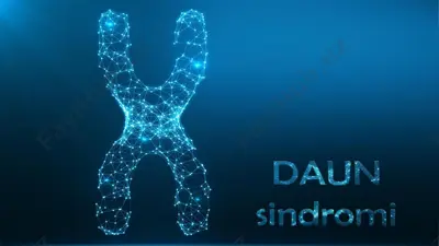 daun sindromi — PPTX