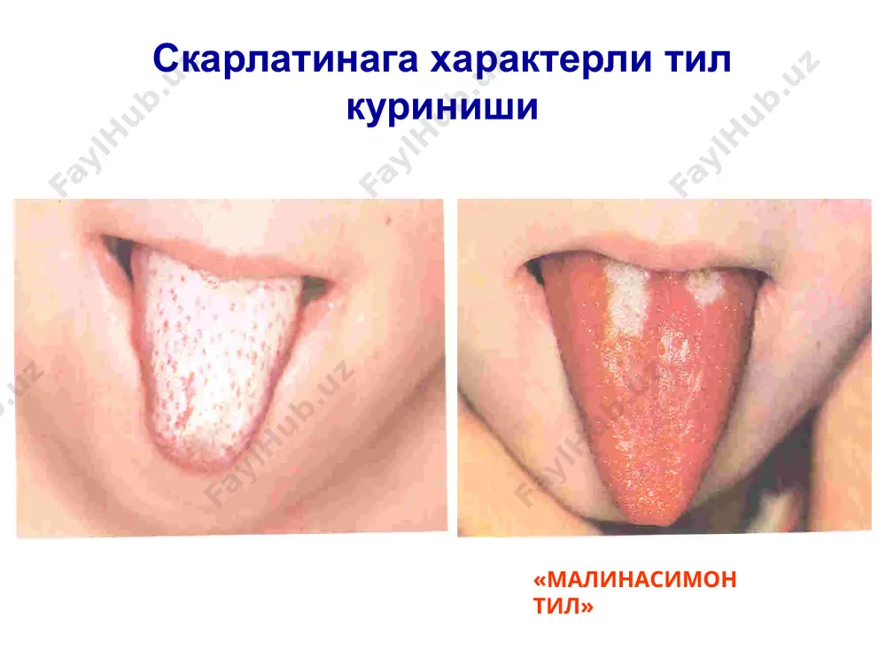 и шароит яратиб бўлмайди. шифохонадан чиқаришга касалликнинг килиник белгилари бартараф бўлгандан кейин ва асоратлари ҳамда бурун, томоқ йўлларидаги яллиғланиш жараёни йўқолгандан сўнггина рухсат этилади. profilaktikasi image1.png image2.png image3.png image4.png image5.png image6.png image7.png image8.png image9.png