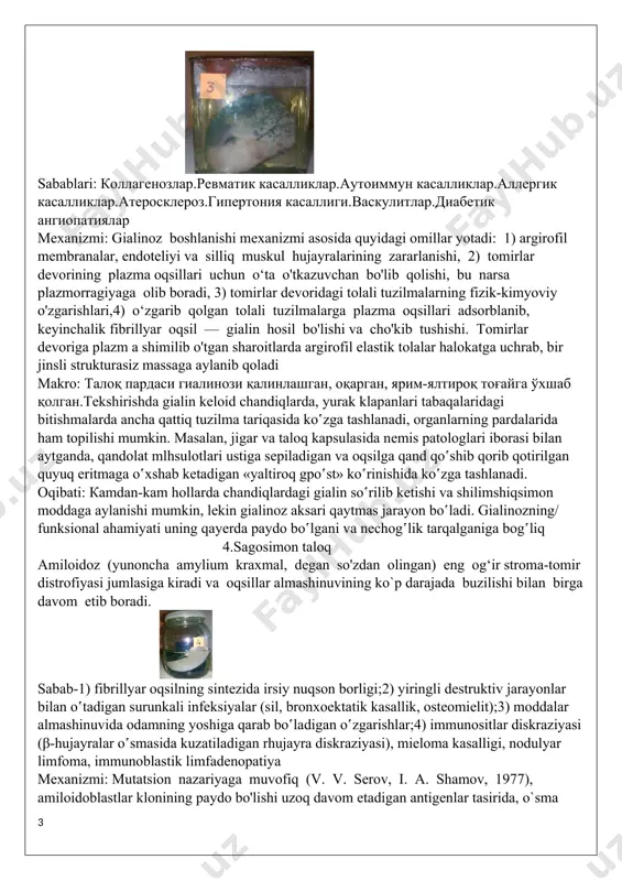 r ko'p darajada izdan chiqadigan bo'lsa, bu holda jigardagi yog' distrofiyasi, y ani yog' gepatozi tabiatan qaytmas tusga kiradi. shunday qilib, ichkilikboz odam , ya`ni alkogolik jigarda hali sirroz boshlanmasdan turib, ichkilik ichishga barham beradigan bo'lsa, u holda kasallik jarayonining orqaga qaytib, jigarning tuzilishi bilan funktsiyalari to`la-to'kis tiklanishi, asliga kelishini kuzatish mumkin. 3. sirlangan taloq gialinoz - biriktiruvchi to`qimada va tomirlar devorida pushti raneli shishasimon qattiqqina gomogen modda to'planib qolishidir. sabablari: коллагенозлар.ревматик касалликлар.аутоиммун касалликлар.аллергик касалликлар.атеросклероз.гипертония касаллиги.васкулитлар.диабетик ангиопатиялар mexanizmi: gialinoz boshlanishi mexanizmi asosida quyidagi omillar yotadi: 1) argirofil membranalar, endoteliyi va silliq muskul hujayralarining zararlanishi, 2) tomirlar devorining plazma oqsillari uchun o‘ta o'tkazuvchan bo'lib qolishi, bu narsa plazmorragiyaga olib boradi, 3) tomirlar devoridagi tolali tuzilmalarning fizik-kimyoviy o'zgarishlari,4) o‘zgarib qolgan tolali tuzilmalarga plazma oqsillari adsorblanib, keyinchalik fibrillyar oqsil — gialin hosil bo'lishi va cho'kib tushishi. tomirlar devoriga plazm a shimilib o'tgan sharoitlarda argirofil elastik tolalar halokatga uchrab, bir jinsli strukturasiz massaga aylanib …