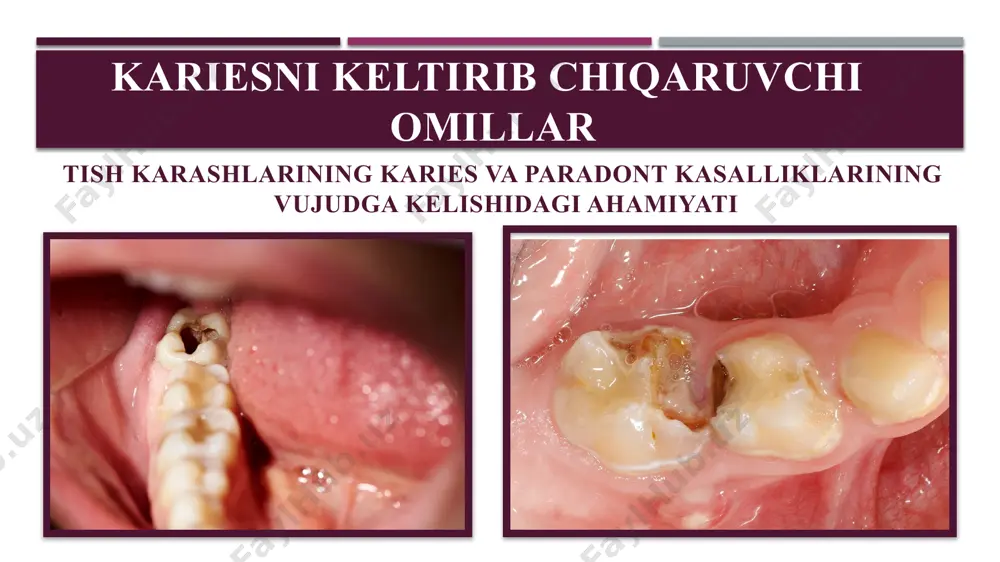 k kislotalarni davomli ta'siri og’iz bo`shlig’i gigienasini pastligi tufayli yuzaga keladi. shunday qilib, tish kariesi intensiv ravishda kislota hosil bo`luvchi tish pilakchasi ta'siri ostida, rn 4-5 bo`lganda yuzaga keladi. kariesogen omillar qand og’iz bo`shlig’ida modda almashinuviga maxsus ta'sir ko`rsatadi, "metobolik portlash" ni keltirib chiqaradi. agar oqsil va yog’lar murakkab gidrolizni talab qilsa, oddiy uglevodlar esa og’iz bo`shlig’idayoq parchalanadi. og’iz bo`shlig’idagi mikroflora tomonidan uglevodlarni iste'mol qilish juda qulaydir. bu esa kariesni intensiv ravishda tarqalishiga sabab bo`ladi. kariesogen omillar tishlarning karies bilan zararlanish intensivligi yoshlarda yuqori bo`lib, qarilarda kamroq, uchraydi. bu tishlar yorib chiqqandan keyingi sust minerallizasiya bilan bog’liq. emalning yetilishi 2 yil davom etadi, faqatgina emalning to`liq mineralizasiyasi tish emalining kislotalar ta'siriga chidamliligini oshiradi yoki aksincha, noto`liq mineralizasiya demineralizasiyani oshiradi va karioz jarayonini keltirib chiqaradi. tishlar yorib chiqqandan keyin, birinchi navbatda tishlarning kesuv qirrasi va do`mboqlaridagi emal yetiladi, shuning uchun karioz jarayoni yetilmagan fissuralar va bo`yin sohasida rivojlanadi. kariesogen omillar kariesogen …