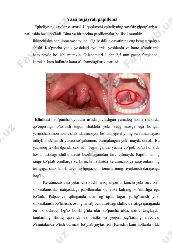 i deb ataladigan turish paydo bo’lishi mumkin, uning xarakterli xususiyati epitelial papillalarning asosiy to’qimalarga chuqur kirib borishi. bir nechta papillomalarning o’sishi-papillomatozdir, og’iz bo’shlig’ida bu kam uchramaydi. papillomatozlarning bir necha turlari mavjud: turli tabiatga ega bo’lgan reaktiv papillomatozlar: a) qattiq tanglay shilliq qavatining va alveolyar o’simtalarning yallig’lanish giperplaziyasi; b) travmatik papillomatoz travmatik ta’sir qiluvchining uzoq muddatli ta’siridan kelib chiqadi, masalan, noto’g’ri qilingan protez, plomba qo’yish, lunj, labni tishlash va ushlab turish va tishlarning distopiyasi. ushbu zonalarda 3-4 ta yumaloq yumshoq hosilalar keng asosda joylashadi. ba’zida og’riq qayd etiladi; v) tilning rombsimon papillomasi rombsimon glossit fonida rivojlanadi. tilning orqa shilliq qavatining giperplaziyasi sohasida zich elastik konsistensiya aniqlanadi. rombsimon papillomatozning rangi til yuzasidagi so’rg’ichning rangiga bog’liq. doimiy travma va keyingi yallig’lanish bilan infeksiyalanish natijasida yuzaga keladigan reaktiv papillomatoz bilan to’qimalarning turg’un giperplaziyasi paydo bo’ladi. travmatik ta’sir bartaraf etilganda, neoplazmaning o’sishi to’xtaydi va neoplazmada biroz pasayish kuzatiladi. biroq, u hech qachon butunlay yo’qolmaydi. gistologiyasi. …