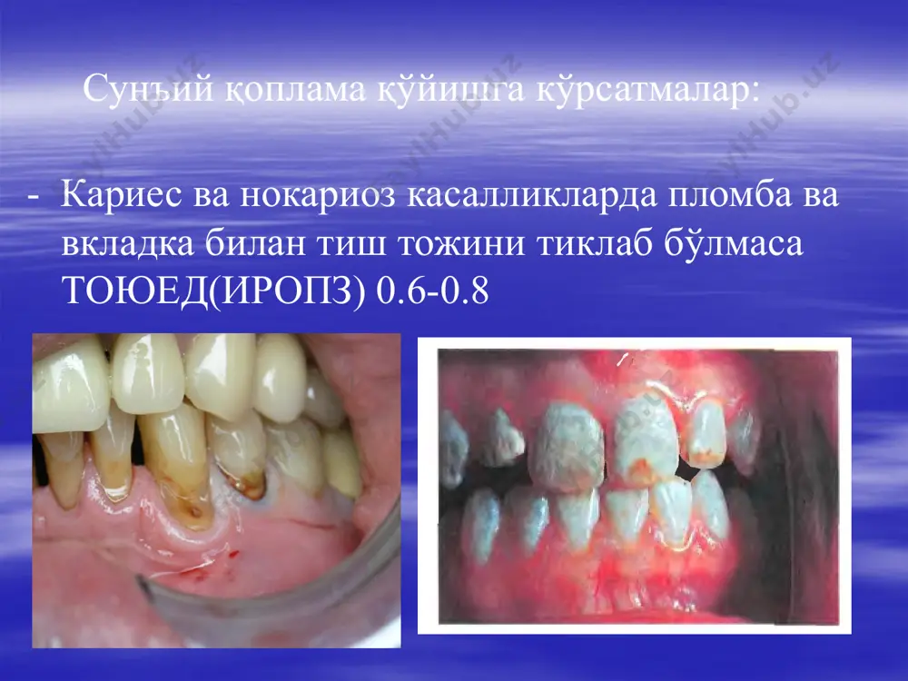 tishlarni sun'iy qoplamalar bilan protezlash - Page 3