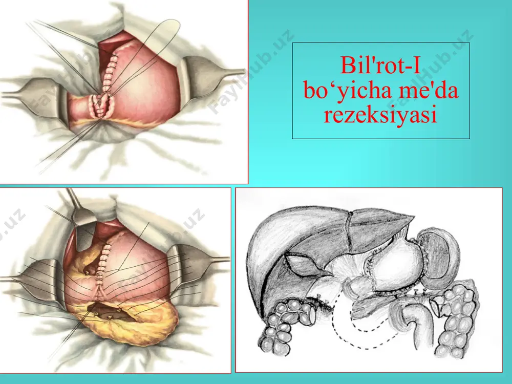 vuzloqga ovqat luqmasini ko‘p miqdorda tushishi, yuqori osmotik bosim paydo bo‘lishi (3000-4000 mosm), ichak devorida qon aylanishini kuchayishi va natijada plazma suyukligini ichak bo‘shlig‘iga tushishi, chirish jaraenlarini kuchayishi............. kollaps va shok belgilarini paydo bo‘lishi, taxikardiya, gipotenziya, umumiy xolsizlik, ozib ketish, v12 defisit anemiya, teri qoplamlari oqish rangda bo‘lishi, ovqat istemol qilishdan qo‘rquv, yegan ovqati bilan qayd qilish................. demping sindrom belgilari: yuraq-qon tomir va neyrovegetativ belgilar: xolsizlik xurujlari, taxikardiya, qizib ketish belgilari, yuz va barmoqlar rangi oqish rangda bo‘lishi, qo‘llar tremori, bosh aylanishi, ko‘z oldini qorong‘ilashishi, sovuq ter bosishi. dispeptik va abdominal diskomfort: ishtahani yo‘qolishi, ko‘ngila aynishi, qayd qilish, qorinni g‘uldirashi, ichni suyuq holda kelishi yoki qotib qolishi. metabolik sistemani yetishmovchiligiga bog‘liq bo‘lgan belgilar: ozib ketish, dispeptik shikoyatlar. gepato-pankreatoduodenal soha yallig‘lanish belgilari: duodenostaz va qorindagi og‘riqlar qorin bo‘shlig‘idagi chandiqli jarayonga bog‘liq. astenizasiya va psixo-nevrologik status buzilishiga bog‘liq bo‘lgan belgilar: uyquvsizlik, bosh og‘rig‘i, nevrosteniya. residiv yaralarni uchrashi me'da ⅔ rezksiyasi - 1 …