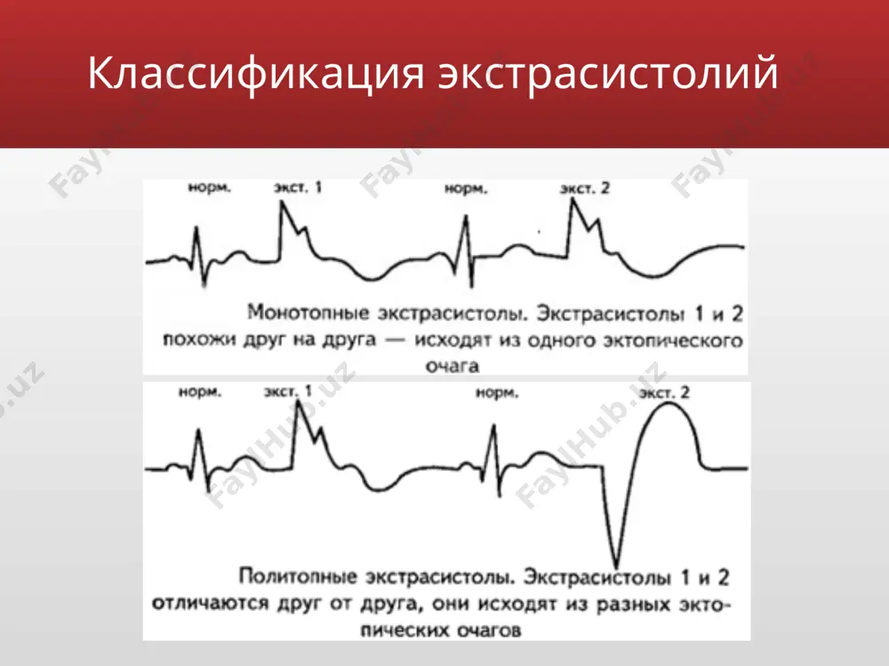 а в проводящей системе желудочков. импульс вызывает преждевременное возбуждение желудочков и не распространяется на предсердия и на синусовый узел, следовательно не происходит преждевременного возбуждения предсердий и разрядки синусового узла. очередной импульс в синусовом узле возникает в обычное время, он вызывает возбуждение предсердий, но не распространяется на желудочки, так как они уже охвачены внеочередным сокращением. возбуждение желудочков происходит необычным путем, сначала возбуждается желудочек, в котором находится очаг, затем позднее происходит возбуждение другого желудочка. экг признаки желудочковых экстрасистол: преждевременное появление на экг измененного комплекса qrs значительное расширение (до 0,12 сек. и больше) и деформация экстра­систолического комплекса qrs расположение сегмента rs — т и зубца т экстрасистолы дискордантно направлению основного зубца комплекса qrs отсутствие перед желудочковой экстрасистолой зубца р наличие после желудочковой экстрасистолы полной компенсаторной паузы электрокардиограмма при разных формах желудочковой экстрасистолии электрокардиограмма при разных формах желудочковой экстрасистолии а — монотопная желудочковая экстрасистолия, экстрасистолические комплексы появляются преждевременно, резко отличаются по форме от желудочковых …