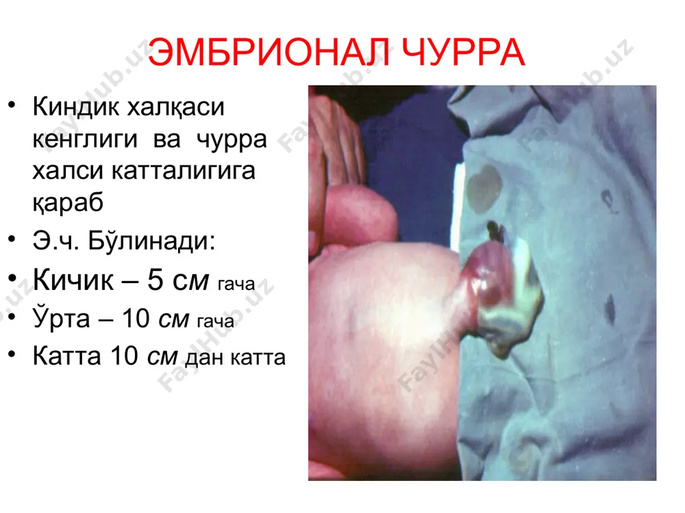 si devoriga churra mahsuloti chandiqli yopishgan) qisilgan (churra mahsuloti churra darvozasi sohasida qisilib, qon va limfa aylanishi buzilib, to'qimalar nekrozi xavfi ortib boradi ) chov, chov-yorg'oq churralari qisilish mexanizmiga qarab: elastik axlatli qisman (ichak devori, siydik qopi devori /rixter qisilish/) retrograd qisilish (hernia maydl) yoki w-simon qisilish. bunda ichak qovuzlog'i tutqichi bilan birga qorin bo'shlig'i ichida qisilib, nekrozlanadi mekkel divertikuli qisilishi – littre churrasi deyiladi davolash printsiplari churralarni davolash – operativ, yani radikal ravishda churra xaltasini olib tashlash hisoblanadi !!! chov kanali old devorini mustahkamlash kattalardagidek, bolalarda unchalik muhim ahamiyatga ega emas !!! bolalarda chov kanali old devorini mustahkamlash uchun ru-krasnobaev, martinov usullari qo'llaniladi qin parda bekilish anomaliyalari qin o'simtasining obliteratsiyalanmaganligi bu nuqsonning asosiy sababchisidir. agar qin o'simtasining terminal qismi obliteratsiya bo'lmay qolsa, gidrotsele kelib chiqadi proksimal qismining bekilib ketmasligidan esa urug' tizimchasining yuqori qismida suyuqlik to'planadi. funikotsele deb shunga aytiladi. qin parda bekilish anomaliyalari agar obliteratsiya urug'don va urug' …