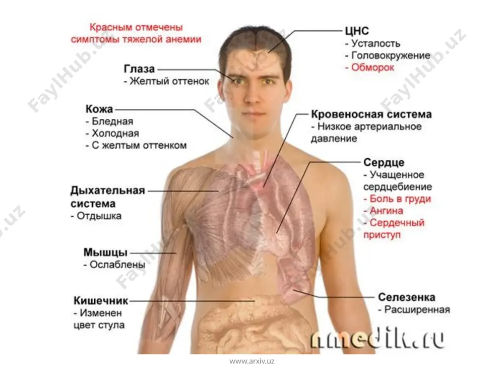 a zaharli ta’sirotlar, keksalikdagi atrofik jarayonlar natijasida ham rivojlanishi mumkin. ichki omil yetishmasligi ichakda bl2 vitamini so‘rilishining buzilishiga olib keladi va qonda bn vitamini yetishmasligi rivojlanadi. natijada folat kislotaning o‘z aktiv formasi folin kislotaga o‘tishi amalga oshmay qoladi. www.arxiv.uz klinik ko‘rinishi. kasallik kechishi siklik bo‘lib, remissiyasi retsidiv davri bilan almashinib turadi. remissiya davrida qon ishlab chiqarish normoblast bo‘lib, kasallikning klinik belgilari kuzatilmadi. kasallikka xos klinik belgilar va periferik qondagi o‘zgarishlar retsidiv vaqtda kuzatiladi. addison-birmer kasalligi, asosan, keksa yoshdagi erkaklarda uchraydi. kasallik bilintirmay rivojlanadi.uning boshlang‘ich belgi­lari quwatsizlik, tez toliqish, og‘iz qurishi, dispeptik o‘zgarishlardan iborat. kam hollarda kasallik asab a’zolaridagi o‘zgarishlar, paresteziya va sezuvchi nerv ildizlaridagi og‘riqlar bilan boshlanadi. xastalik qaytalaganda uch sindrom (kamqonlik, oshqozonichak va nevrologik) belgilar kuzatiladi. www.arxiv.uz laborator tekshiruvi natijalarida qondagi o‘zgarishlar o‘ziga xos, pernitsioz anemiya giperxrom boladi: rang ko‘rsatkichi birdan yuqori (eritrotsitlar umumiy miqdori kamayganda, ulardagi ge- moglobin miqdori oshgan boladi), yirik eritrotsitlar— makrotsitlar, shuningdek, poykilotsitlar (odatdagi yumaloq …