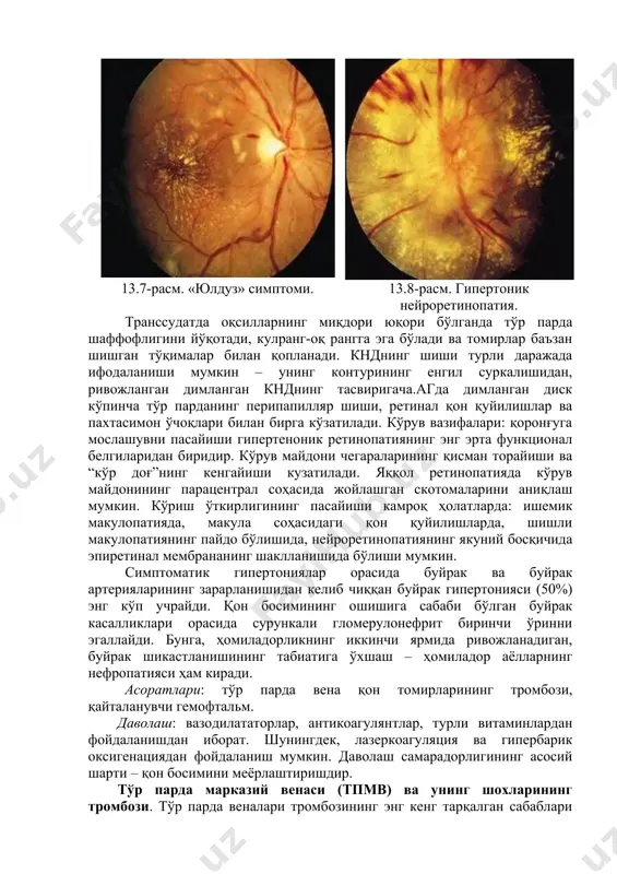 ngan dimlangan kndning tasvirigacha.agda dimlangan disk ko'pincha to'r pardaning peripapillyar shishi, retinal qon quyilishlar va paxtasimon o'choqlari bilan birga ko'zatiladi. ko'ruv vazifalari: qorong'uga moslashuvni pasayishi gipertenonik retinopatiyaning eng erta funktsional belgilaridan biridir. ko'ruv maydoni chegaralarining qisman torayishi va “ko'r dog'”ning kengayishi kuzatiladi. yaqqol retinopatiyada ko'ruv maydonining paratsentral sohasida joylashgan skotomalarini aniqlash mumkin. ko'rish o'tkirligining pasayishi kamroq holatlarda: ishemik makulopatiyada, makula sohasidagi qon quyilishlarda, shishli makulopatiyaning paydo bo'lishida, neyroretinopatiyaning yakuniy bosqichida epiretinal membrananing shakllanishida bo'lishi mumkin. simptomatik gipertoniyalar orasida buyrak va buyrak arteriyalarining zararlanishidan kelib chiqqan buyrak gipertoniyasi (50%) eng ko'p uchraydi. qon bosimining oshishiga sababi bo'lgan buyrak kasalliklari orasida surunkali glomerulonefrit birinchi o'rinni egallaydi. bunga, homiladorlikning ikkinchi yarmida rivojlanadigan, buyrak shikastlanishining tabiatiga o'xshash – homilador ayollarning nefropatiyasi ham kiradi. asoratlari: to'r parda vena qon tomirlarining trombozi, qaytalanuvchi gemoftalm. davolash: vazodilatatorlar, antikoagulyantlar, turli vitaminlardan foydalanishdan iborat. shuningdek, lazerkoagulyatsiya va giperbarik oksigenatsiyadan foydalanish mumkin. davolash samaradorligining asosiy sharti – qon bosimini meyorlashtirishdir. …
