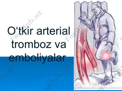 o‘tkir arterial tromboz va emboliyalar — PPTX