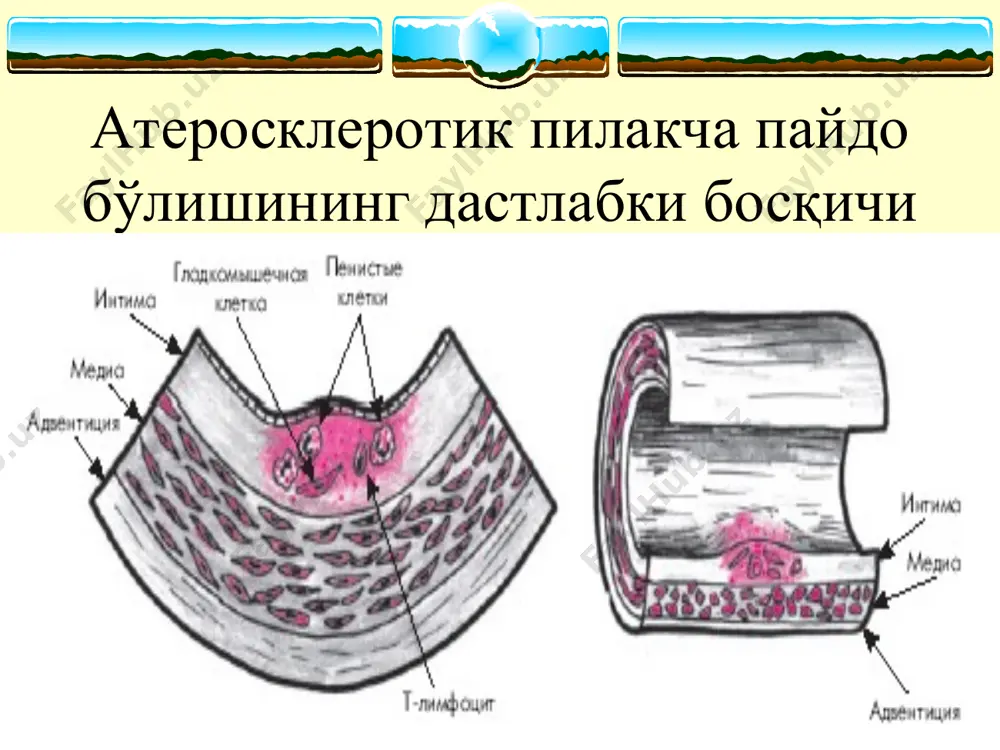 атеросклероз - Page 5