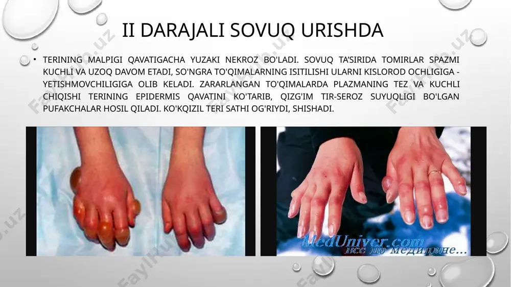 sizlantirish bilan olib borish zarur. umumiy sovqotish umumiy sovqotish kam harakat qilganda sovuq ta ’sirida paydo bo'ladi. tinchlik paytida kam uchraydi (kema halokati, alpinistlarda ko'ngilsiz voqealar, alkogoldan chuqur zaharlanish, hushdan ketish, koma holati va b.). urush davrida umumiy sovqotish ko'p uchraydi, unda qon ketadi, shok ta ’sirida tana harorati pasayib ketadi va organizm sovuq urishga moyil bo'ladi. sovuq avvalo tana haroratini pasaytiradi, periferik tomirlar lisqarib teri oqaradi, u elastikligini yo'qotib, qurib, g'adir-budur bo'ladi «g'oz» terisi), mushaklar qisqarishi natijasida tuk va sochlar tiklanadi, tana harorati 35°c da yuz oqaradi. sianoz, tizza, tovon va jinsiy organlarda og 'riq bo'ladi, siydik kelishi tezlashadi (poliuriya «sovuq diurezi»). kayfiyat buzilib befarqlik, apatiya paydo bo'ladi, charchash uyqug ortadi. bemorda gallyutsinatsiya yuzaga kelib, bemor o'zini issiq uyda leb his qiladi. umumiy sovqotish to'rt fazadan iborat sovishning birinchi fazasida chekka vazokonstriksiya tufayli issiqlik losil bo'lishining ko'payishi natijasida bemor harorati +37°c atrofida uradi. ikkinchi fazasida maksimal issiqlik bo'lishidan tashqari …