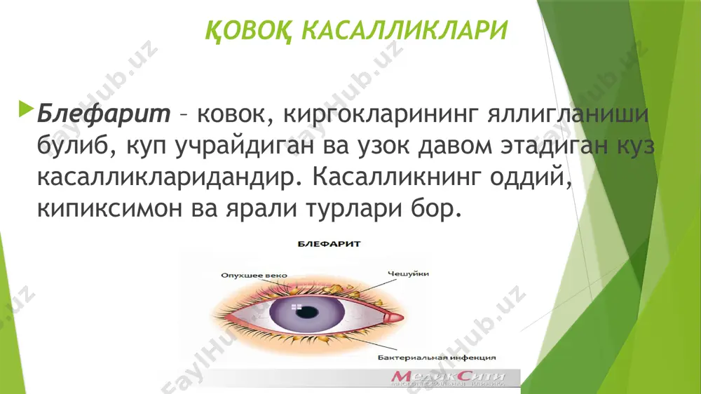 ли пустлоклардан тозалаш ва 1% бриллиант яшил билан суртиб туриш керак қовоқ нерв-мушак аппарати касалликлари. аиланма мушак спазми – блефароспазм, шох парда касалликларида учрайдиган рефлектор холатдир. ёругликдан куркиш окибатида қовоқлар юмилиб колган, бемор кўзларини очолмайди. шох пардадаги процесслар даволаниб булгандан сунг бу холат йуколади. конъюнктива касалликлари конъюнктивитлар учун куйидаги умумий белгилар характерли: кузда кизариш, шиш булиши, куз тиркиши юмилиб, йирингли ва бошка ажралмалар чикиши. конъюнктивитларнинг таснифи: таркалган. учокли. доначалик. таркалган конъюнктивитлар уткир ва сурункали булади. дифтерияли конъюнктивит – уткир юкумли касаллик булиб, леффлер таёкчалари билан чакирилади. белгилари: ковок териси шишади, кукимтир булиб кизаради, каттик булиб колади, куз тиркиши юмилади, йирингли фибриноз ажралма чикади. конъюнктива кизаради, шишади, устида кир кул ранг парда тупланади, буни кучирилса конайдиган яра куринади. даволаш даволаш: кузга кунига беш-олти мартадан левомицетин 0,25% ва бошка дезинфекцияловчи томчилар, дифтерияга карши зардоб томизилади, мушакка дифтерияга карши зардобдан 6000-10000 ае юборилади. сурункали конъюнктивит моракс-аксенфельд таёкчала­ри билан чакирилади. белгилари: конъюнктива бир оз …