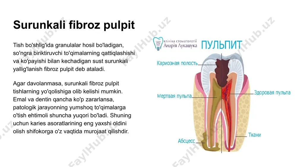surunkali fibroz pulpit - Page 4