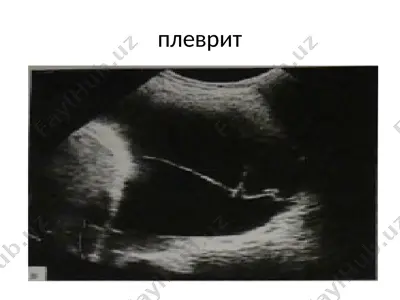 plevrit — PPTX