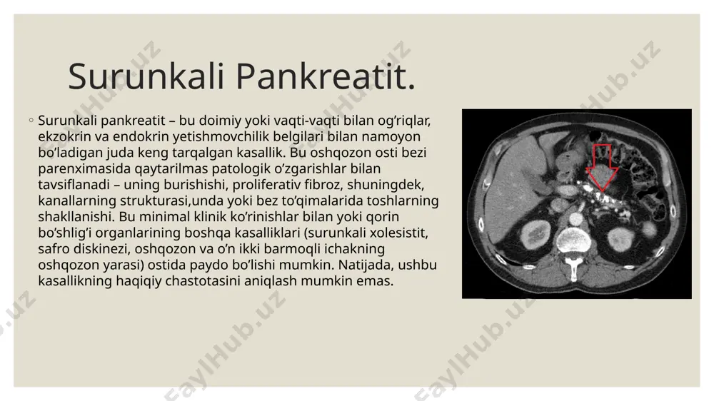 a’zida oshqozon osti bezi boshidagi sklerotik jarayonlar o’t yo’llari va oshqozon osti bezi kanalining siqilishiga o’xshash klinik ko’rinishga olib keladi. xuddi shunday ko’rinish oshqozon osti bezi boshining o’smalarida kuzatiladi, shuning uchun pankreatitning bu shakli psevdotumor deb ataladi. bunday hollarda safro chiqishi buzilishi obstruktiv sariqlikka olib kelishi mumkin. surunkali pankreatit fonida o’tkir pankreatit paydo bo’lishi mumkin, bu surunkali pankreatitning kuchayishi bilan teng emas. oshqozon-ichak traktining buzilishidan tashqari, surunkali pankreatit bilan og’rigan bemorlarda boshqa belgilar mavjud. 90% surunkali pankreatit bilan og’rigan bemorlarda mavjudligini tasdiqlovchi adabiy manbalar mavjud. polinevropatiyalar (periferik nervlarning funksional o’zgarishlari bilan bog’liq) holatlarining. diagnostika. surunkali pankreatitni tashxislash uchun standart tekshiruvdan tashqari, oshqozon osti bezining ekzokrin funksiyasi ham muhimdir. buni koprogram yordamida aniqlash mumkin (najasdagi hazm bo’lmagan oziq-ovqat qoldiqlarini mikroskopik tahlil qilish). instrumental tadqiqotlar ham qo’llaniladi: qorin bo’shlig’i organlarining ultratovush tekshiruvi, qorin bo’shlig’i organlarining kompyuter tomografiyasi va boshqalar. bemorlar chapqovurg’a osti sohasida zerikarli og’riqli og’riqlardan shikoyat qiladilar, ular boy va yog’li …