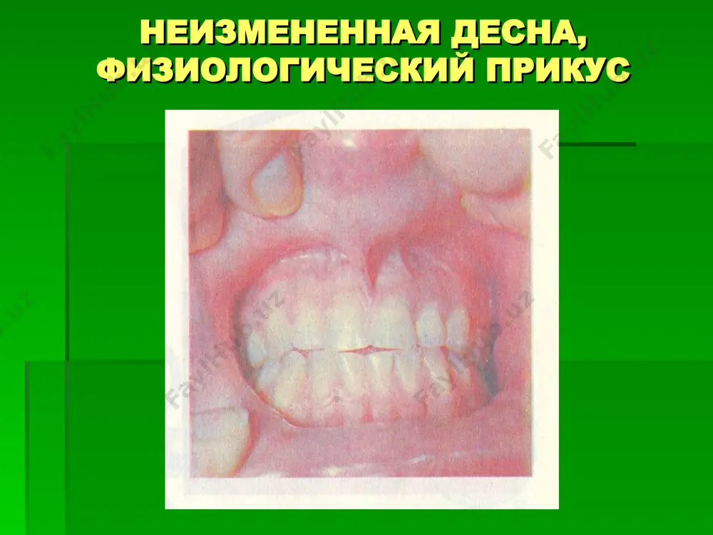 ebaniya visoti mejalveolyarnix peregorodok na rentgenogrammax a – vershina vishe emalevo-tsementnogo soedineniya. 44,45,46-zubi b – vershina nije emalevo-tsementnogo soedineniya. 44,45,46-zubi v – vershina na urovne emalevo-tsementnogo soedineniya. 84,85,46-zubi rentgenologicheskie priznaki zabolevaniy parodonta a – destruktsiya kompaktnoy plastinki. 31,32,41,42-zubi b – osteoporoz. 31,32,41,42-zubi v – rasshirenie periodontalnoy sheli. 31,32,41,42-zubi rentgenologicheskie priznaki zabolevaniy parodonta g – rezorbtsiya mejalveolyarnix peregorodok. 31,32,41,42-zubi d – obrazovanie kostnix karmanov. 44,45,46-zubi e – sekvestratsiya kostnoy tkani. 31,32,33-zubi a – destruktsiya kompaktnoy plastinki. 31,32,41,42-zubi b – osteoporoz. 31,32,41,42-zubi v – rasshirenie periodontalnoy sheli. 31,32,41,42-zubi g – rezorbtsiya mejalveolyarnix peregorodok. 31,32,41,42-zubi d – obrazovanie kostnix karmanov. 44,45,46-zubi e – sekvestratsiya kostnoy tkani. 31,32,33-zubi rentgenologicheskie priznaki zabolevaniy parodonta parodontoz, legkaya stepen. ortopantomogramma gorizontalnaya rezorbtsiya alveolyarnoy kosti sxema rentgenografii zuba podgotovka k rentgenografii. (sxema). 1- rentgenovskaya trubka 2 – plenka 3 - kasseta panoramnaya rentgenografiya zubov verxney chelyusti ortopantomogramma chelyustey