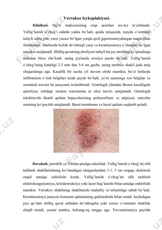 ydo bo’lishi mumkin, bu esa bemorlarni og’riqdan shikoyat qilishga olib keladi, ayniqsa ovqat paytida. gistologik jihatdan stromada limfotsitlar inaktivatsiyasi bilan diffuz surunkali yallig’lanish aniqlanadi. epiteliya qatlamlari soni keskin oshadi, o’simta oldi jarayoni muhim korneum qatlami shakllanishi bilan sodir bo’ladi. davolashsiz 20% bemorlarda xavfli o’sma bilan kasallanish kelib chiqadi. davolashni chekishni to’xtatish emas, balki og’iz bo’shlig’ini reabilitatsiya qilish, mumkin bo’lgan travmatik omillarni bartaraf etish, o’xshash bo’lmagan metallarni olib tashlash bilan boshlash kerak. konservativ davo bilan, agar leykoplakiyaning verrukoz shakli tekis shaklga mustaqil o’ta olmaydi, jarrohlik amaliyoti talab etiladi. konservativ davolanish muddati 3-4 haftadan oshmasligi kerak. papillomatoz-bu ko’p papilloma. klinikasi: og’iz bo’shlig’ining atrofidagi shilliq qavat ustida ko’tarilgan va ingichka oyog’iga ega bo’lgan xosilalar, bir qator kuzatuvlarda bir nechta papillomalar bitta keng asosga ega. papillomalarning yuzasi silliq yoki notekis. keratinizatsiya jarayonlari mavjud bo’lganda, papillomalar kulrang-oq rangga ega va tashqi ko’rinishida "gulkaram" ga o’xshaydi. papillomatoz ko’pincha tanglay, til, yonoqlarning shilliq qavatida uchraydi. gistologik jihatdan …
