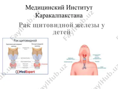 рак щитовидной железы у детей — PPT