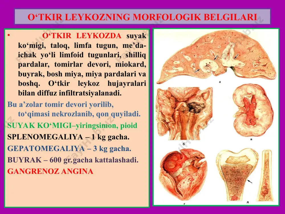 shlanadigan anemiyalar suyak kumigining gemopoez uchun zarur moddalar bilan ta’minlanmaginligidan kelib chikuvchi anemiyadir. 1. temir tankisligiga boglik anemiya sababi: a) alimentar temir yetishmovchiligi; b) organizning temir moddasiga extiyoji ortishi; v) temir moddasining me’da ichak traktidan surilishining buzilishi. mexanizmi: gemoglobin sintezida ishtrok etuvchi va uz tarkibida temir saklovchi fermentlarning temir yetishmasligi natijasida sintezining susayish, gem sintezi uchun zarur fe +2 ning yetishmasligi natijasidagemoglobin sintezining susayishi. okibati: 1. me’da ichak yullarida atrofik jarayonlar 2. atrofik glossit,gingivit,plammer-vinson sindromi; 3. miokard yeg distrofiyasi; 4. jigar yeg distrofiyasi. makro: - teri va shillik pardalar rangi okarishi; uzok davom etgan anemik gipoksiyaga boglik xoda jigarning yegli distrofiyasi mikro: kumik kesmasi giperplaziyasi, normoblastlar uchtunligi, peralu usuli bilan buyalganda kumikda gemosiderin granulalari kurinmaydi. 2. megaloblastik anemiya a. folat k-ta tankisligidan kelib chikuvchi anemiya. sababi: a) folat k-taning endogen yetishmovchiligi;b) folat k-taning alimentar yetishmovchiligi;v) folat k-taga organizmning extiyoji ortishi;g) folat k-taning ichakdan surilish buzilishi. mexanizmi: folat k-ta yetishmovchiligi natijasida …