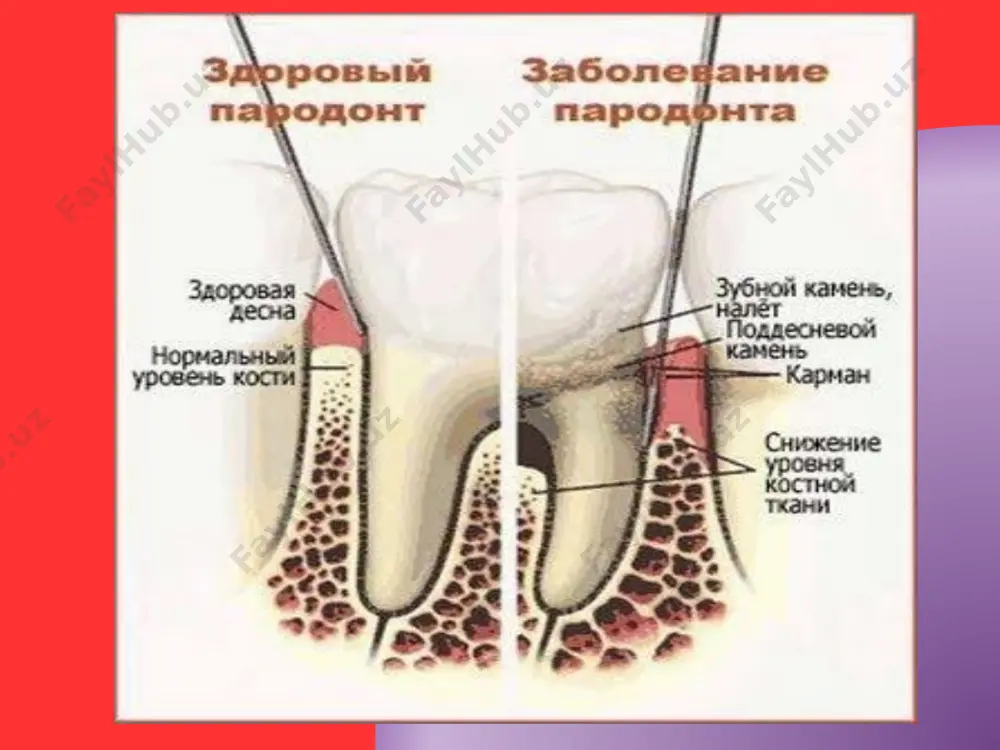 челюсти (артикуляция) чрезвычайно разнообразны и включают в себя не только центральное, переднее, боковые, но и дистальное положение нижней челюсти. артикуляция зубных рядов при функции заключается в циклической смене статической и динамической фаз, а преобладание некоторых из них определяется видом прикуса индивидуума. . статическая фаза представляет собой различные виды смыкания (окклюзии) зубных рядов: дистальную, центральную, переднюю и боковые окклюзии. динамическая фаза представляет собой перемещение (экскурсию) нижнего зубного ряда из исходной центральной окклюзии в различные краевые окклюзии, т. е. дистальную, переднюю и боковые окклюзии, и в обратном направлении. на наш взгляд, пришлифовывание должно быть направлено на создание множественного, плавного и одновременного контакта зубов при всех функциональных положениях и движениях нижней челюсти у данного пациента. для анализа окклюзионных (артикуляционных) взаимоотношений зубных рядов, определения локализации супраконтактов и последующего их избирательного пришлифовывания предложено много классификаций различных участков зубных рядов. распространенная в литературе классификация бугров зубов, которая делит их на удерживающие высоту центральной окклюзии и направляющие …