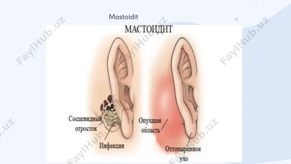 antrit va mastoidit differensial diagnostika - Page 3
