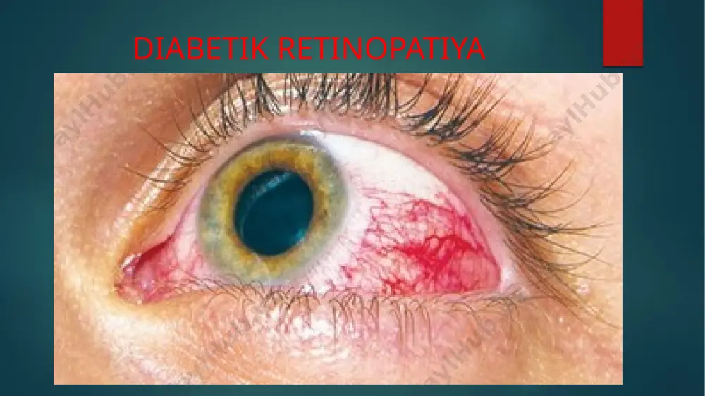diabetik retinopatiya - Page 2