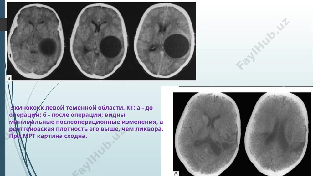 parazitarnie bolezni nervnoy sistemi - Page 4