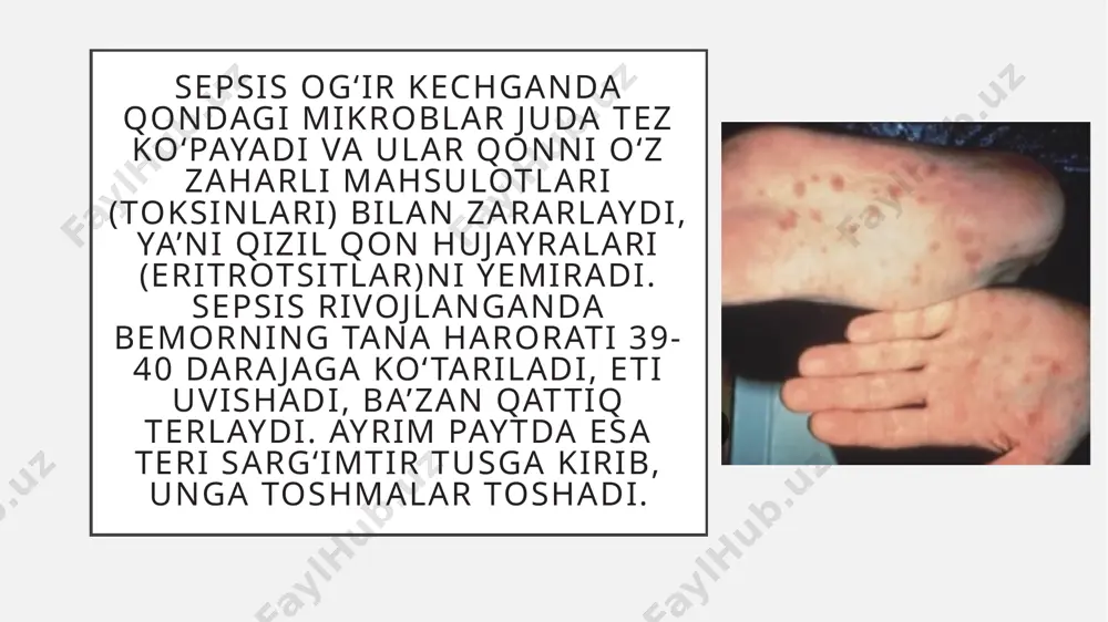 oplamasining rangi ochiqligi, bola qusishi, tana vaznining keskin kamayishi, sariqlik belgilarining kuchayishi, teri va shilliq pardalardagi qonli toshmalar, piodermiya, omfalit, zotiljam, kon’yunktivit va boshqa shu kabi belgilar kuzatiladi septisemiya – yiringli asoratsizlarsiz, faqat qon zararlanishi va intoksikatsiya bilan kechishiga aytiladi. septikopiyemiya – a’zolarning biror yerida yiringli yallig‘lanishi, mikrobning bu yerdan qonga o‘tishi va qon bilan butun badanga tarqalib, turli a’zolarda yiringli jarayonlar bo‘lishiga aytiladi. absets, flegmona, yiringli zotiljam, suyaklarning yiringli yallig‘lanishi (osteomiyelit) va boshqalar uchraydi. zaharlanish belgilariga nafas va yurak qon tomirlari yetishmovchiligi qo‘shiladi va u teri qoplami ko‘karishi, asfiksiya xuruji, taxikardiya yoki taxiaritmiya ko‘rinishida bo‘ladi diagnostik mezonlari chaqaloqlar sepsisiga tashhis qo‘yishda homiladorlik vaqtida homilaning yuqumli kasallik qo‘zg‘atuvchilari bilan zararlanishi (onada yallig‘lanish kasalliklari, o‘choqlari bo‘lishi)  umumiy klinik belgilar to‘plamining bo‘lishi  periferik qonda leykositoz, neytrofilyoz, leykositar formulaning chapga siljishi, eritrositlar, gemoglobin miqdorining kamayishi, echt (eritrositlar cho‘kish tezligi) oshishi  qon va a’zolar suyuqliklarida mikroflora o‘stirish ijobiy natija beradi davosi: …