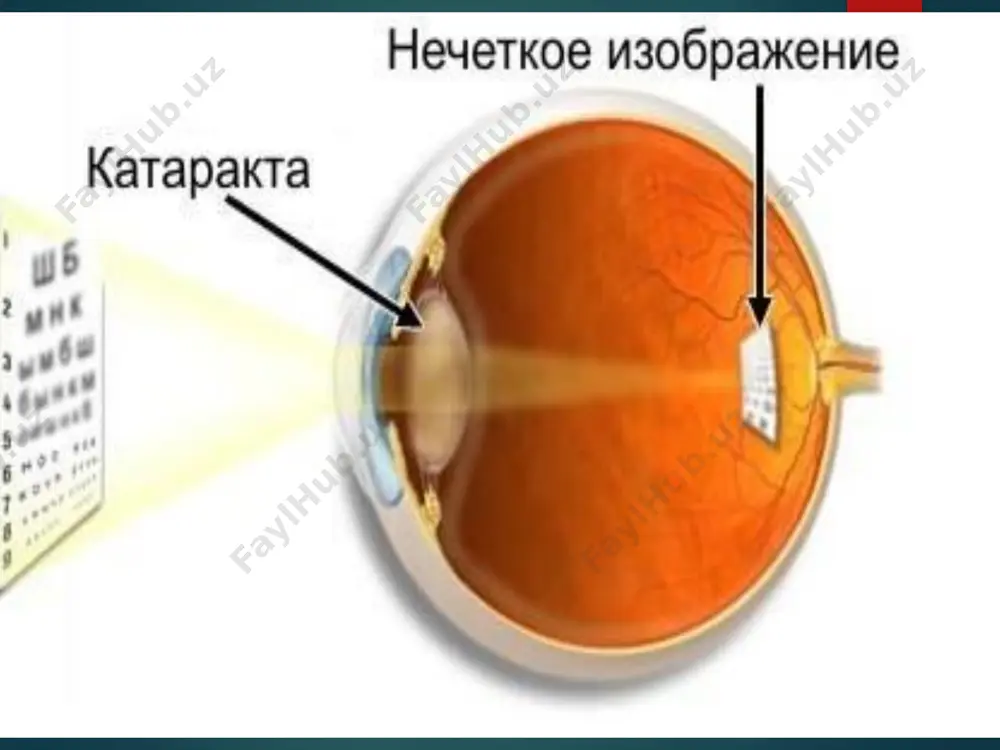 glyadit upakovka akrisof iq. sferik optika asferik optika fakoemulsifikasiya operasiyasidan keyin turli iol qo’yilgan bemorlarning ko’rish o’tkirligini taqqoslash 20 naglyadno raznitsu v kachestve izobrajeniya pri ispolzovanii sfericheskix i asfericheskix linzax vi mojete videt na primere etoy kartinki. izobrajenie, poluchennoe pri ispolzovanii sfericheskoy optiki, (sleva) otlichaetsya razmitostyu i chastichnoy iskajennostyu osobenno u periferii, v to vremya kak asfericheskaya optika daet chetkuyu i kontrastnuyu kartinku. acrysof toric – katarakta astigmatizm bilan birga kelganda qo’llaniladi acrysof toric operasiya natijasida bemor maksimal bo’lishi mumkin bo’lgan va sifatli ko’rish o’tkirligi tiklaydi, eng o’ng tarafdagi rasmdagidek. nex-acri iol nidek firmasi (yaponiya) – rossiyada yagona gidrofob intraokular linza preloaded – bir martalik steril injektorda chiqariladi. aspira -aay (human optics) yumshoq gidrofil asferik to’r pardani himoya qiluvchi sariq filtrli iol. psevdoakkomadasiyalanuvchi iol acrysof® restor® - o’zining mahsus tuzilishi tufayli yaqinga va uzoqqa ko’rishni sifatli ta’minlab beradi. katarakta jarrohligining rivojlanish yo’nalishlari kesmaning kamayishi 3,2 – 3,0 – 2,75 – …