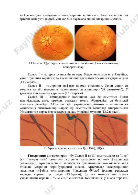 osqichi farqlanadi: to'r pardaning gipertonik angiopatiyasi – gipertoniya kechishining birinchi bosqichiga xosdir – qon tomirlarining funktsional buzilishlari va bosimning beqarorligi. ko'z qon tomirlarida hali organik o'zgarishlar yo'q. biroq, ham venalar, ham arteriyalarning passiv kengayishi tufayli ko'z tubining giperemiyasi kuzatilishi mumkin. keyinchalk arteriyalarning spazmi paydo bo'ladi, u bir qator qon tomir alomatlarida namoyon bo'ladi, ular orasida eng xarakterlisi gvist simptomi (13.1-rasm) – sariq dog' maydonini o'rab turgan mayda tomirlarning shtoporga o'xshash burmalanishi va salyus-gunn simptomi – tomirlarning kesishmasi. agar taranglashgan arteriya vena ustida yotsa, uni har xil darajada siqib chiqarishi mumkin. 13.1-rasm. to'r parda venalarining kengayishi, gvist simptomi, gemorragiyalar. salyus i – arteriya ostida yotgan vena biroz yupqalashganga o'xshaydi, uning bo'shlig'i toraygan; bu kasallikning dastlabki bosqichiga to'g'ri keladi (13.2.a-rasm). salyus ii – tomirning nafaqat qisman siqilishi, balki uning yon tomonga va to'r pardaning qalinligiga siljishidir ("yoy simptomi"). u o'rtasida yupqalashgan ko'rinadi (13.2.b-rasm). salyus iii – tomirlarning kesishishi ham yoy simptomi bilan …