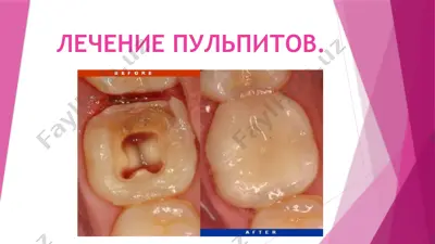 лечение пульпитов — PPTX