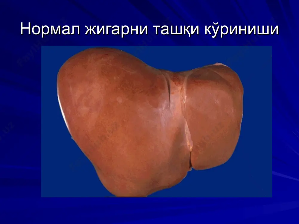 ади. вирус касалликнинг уткир формасини чакиради ва согайиш билан якунланади. касаллик диагнози учун факат серологик маркер мавжуд, вирусни морфологик маркери йук. вирусли гепатит в. юкиш йули парентерал – инъекциялар оркали, кон куйиш, тиббий манипуляциялар. хозирги кунда дунёда 300 млн гепатит в вируси ташувчиси мавжуд. в 1958 й. бламберг австралиялик абориген конида антиген топди. кейинги тадкикотлар бу вирусни бир нечта антиген детерминантлари борлигини исботлади. 1) hbsag — вируснинг юза антигени, гепатоцит цитоплазмасида репродуцирланади — вирус ташувчанлик курсаткичидир. 2) hbcag — чукур антиген, ядрода репродуцирланади, днк-курсаткич репликациясини тутади. 3) hbeag — цитоплазмада аникланади, вируснинг репликацион активлигини курсатади. вирус серологик ва морфологик маркерларга эга. вирусли гепатит d (дельта-гепатит). дельта вируси — дефектли рнк-вируси, в вирусини юза антигени булганда касаллик чакиради, шунинг учун бунга суперинфекция деб караш мумкин. агар касаллик в вируси ва дельта-вирус натижасида келиб чикса, уткир гепатит булади. агар гепатит в бор одам дельта-вирус билан зарарланса клиникада бу холат кайталанишга ва тезда …