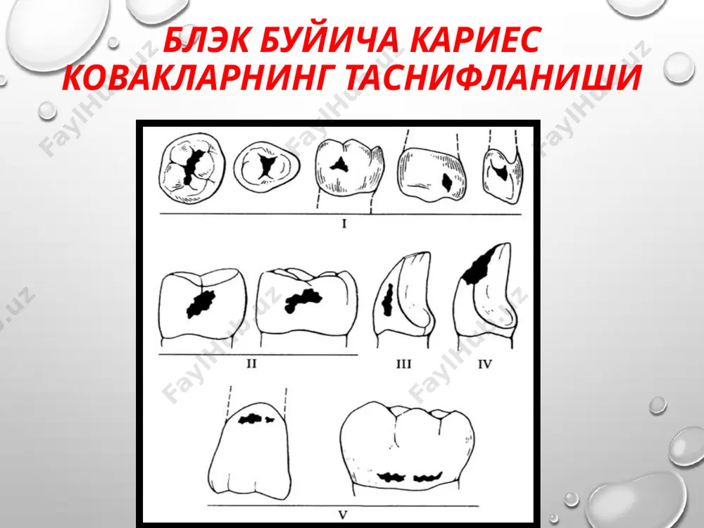 ii синф кариоз бушликларини чархлаш ва пломбалаш - Page 3