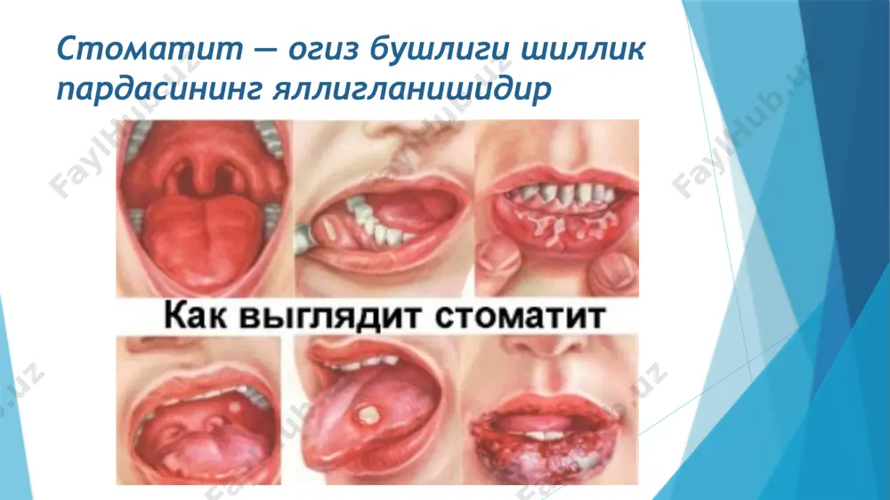 adi. surunkali gastritni tasnifi 1.etiologiyasi va patogenezi bo‘yicha: gastritni a,v va s turlari ajratiladi. 2.topografiyasi bo‘yicha: antral, fundal, gastrit va pangastrit formalari kuzatiladi. 3.morfologik o‘zgarishlari bo‘yicha: yuzaki (atrofik bo‘lmagan) va atrofik gastrit yara kasalligi surunkali kasallik bo‘lib, morfologik substrati oshqozonda va 12 barmoqli ichakda surunkali retsidivlanuvchi yara bo‘lishi bilan xarakterlanadi piloroduoldenal yaralarni patogenezi. adashgan nervni gipertonusi, peptik omilni faolligini oshadi oshqozonni va 12 barmoq ichakni motorikasini buzilishi ro‘y beradi aktg va glyukorkortikoidlarni miqdori ko‘payadi. oshqozon tanaqismidagi yarasini patogenezi. gipotalamo – gipofiraz sistemasini funksiyasi pasayadi adashgan nervni va oshqozon sekretsiyasini tonusini kamayishiga olib keladi. shilliq qavatni ximoya omillari kuchsiz-lanadi. surunkali yara a) eroziya bosqichi – bu yuzaki defekt shilliq qavatini nekrozi. b) o‘tkir yara bosichi – ancha chuqur defekt oshqozonni devorida xamma qavatlari shikastlanadi. noto‘g‘ri shakilli dumaloq yoki oval yara chetlari yumshoq bo‘ladi yara kasalliklarini asoratlari yarali – destruktivli yarani perforatsiyasi (teshilishi) yara penetratsiyasi yaradan qon ketishi yallig‘lanishli gastrit, perigastrit, duotsenit, …