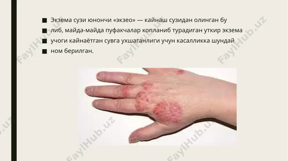 тери шишиши, кизариши, шунингдек уткир тошмалар тошишининг тухташи ва кичишишнинг сезиларли даражада камайиши билан ифодалана­ди. экземанинг 6 хафтагача булган даври уткир ва бундан кейингиси уртача уткир хисобланади. сурункали экземага клиник ва гистологик жихатдан яллигланиш инфильтрацияси хос, шу сабабли зарарланган жой те­риси зичлашиб, калинлашади. инфильтрацияли, эластиклик ху­сусияти кам булган терида окиш, саргиш-жигарранг ёки кизгимтир пустлокларни, баъзан тугунча ва пуфакчаларни учратиш мумкин. маълум бир нокулай омиллар таъсирида сурункали экземанинг зурайиши курилади; бунда терининг кизарган жойи купайиб, шиш ва тошмалар пайдо булади. экземада кузатиладиган морфологик элементлар: папулёз везикуляр пустулёз сквамоз пустлокли дисгидротик экзема. кул ва оёк. кафтида майда нухотдек кат- тик, пуфакчалар хосил булиши билан кечади. тери салгина киза­ риб пуфакчалар ёрилади ва урнида шилинган из колдиради, улар усти саргиш пустлокчалар билан копланади, баъзида пу­ факчалар ёрилмасдан ичидаги суюклиги билан котиб колиш холлари хам кузатилади. касалланган соха атрофидаги сог те- ридан кескин ажралиб туради микробли экзема юзаки пиодермия иккиламчи яллигланиб экземага айланади. асосан …