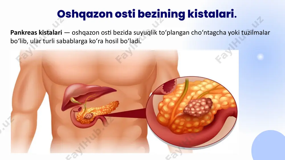 fiya (erxpg) — oqma joyini aniqlash va davolash. oqma suyuqligini laboratoriya tahlili. oqmaning kontrastli rentgen tasviri. oqmaning ultratovush tekshiruvida ko’rinishi davolash. konservativ: kasalxonada davolash, dam olish. yog‘larni cheklash bilan ovqatlanish. antibiotiklar (infeksiya bo‘lsa). pankreatik ferment preparatlari. oqma yoki kistalarni drenaj qilish. davolash. jarrohlik: katta yoki murakkab oqmalarda. pankreasning zararlangan qismini olib tashlash. oqmani yopish yoki qayta tiklash. pankreatik suyuqlik chiqaruvchi yo‘l yaratish. endoskopik: protoklarga stent qo‘yish. oqmani yopish. e’tiboringiz uchun raxmat! image1.png image2.svg image3.png image4.svg image5.jpeg image6.png image7.svg image8.png image9.svg image10.png image11.svg image12.jpeg image13.png image14.jpeg image15.jpeg image16.jpeg image17.jpeg image18.png image19.jpeg image20.jpeg /docprops/thumbnail.jpeg