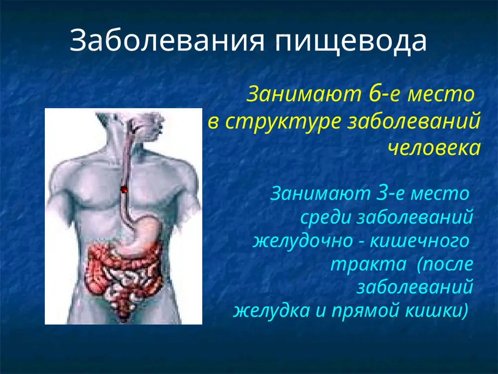 ция заболеваний пищевода i. пороки развития 1. врожденная атрезия пищевода и пищеводнотрахеальные свищи 2. врожденные стенозы пищевода 3. врожденная мембранная диафрагма пищевода 4. врожденный короткий пищевод 5. врожденные эзофагеальные кисты 6. аномалии сосудов ii. повреждения 1. травматические повреждения - наружные и внутренние 2. ожоги пищевода и их последствия iii. заболевания пищевода 1. дивертикулы - пульсионные и тракционные 2. воспалительные заболевания - эзофагит iv. опухоли пищевода 1. доброкачественные опухоли 2. злокачественные опухоли v. нарушение моторики пищевода (кардиоспазм) 1. ахалазия 2. эзофагоспазм частота поражений пищевода рак саркома полипы кардиоспазм рубцовые стриктуры дивертикулы эзофагит туберкулез сифилис 60-80 0,04 0,04 5,1 0,7 0,6 0,2 0,02 0,08 рак пищевода составляет 3,4% всех злокачественных новообразований степени дисфагии i степень - проходит любая пища, но при глотании твердой пищи возникают неприятные ощущения (жжение, царапанье, иногда боль) ii степень - твердая пища задерживается в пищеводе и проходит с трудом, приходится запивать твердую пищу водой iii степень - твердая …