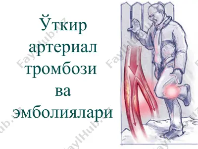 ўткир артериал тромбози ва эмболиялари — PPT