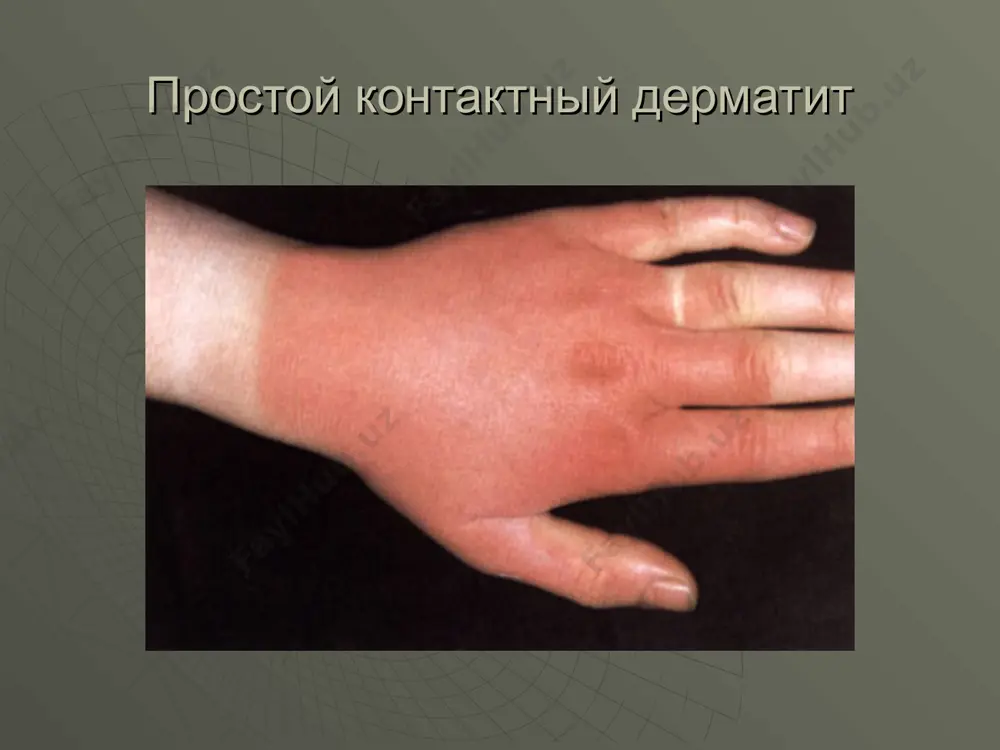 аллергодерматозлар, дерматитлар, токсикодермиялар - Page 5